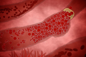 Ši liga besimptomė, tačiau kasmet nusineša tūkstančius gyvybių