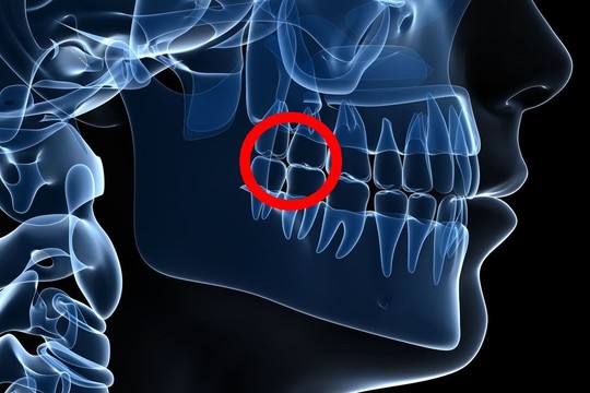 Nemaloniausia, ką teko patirti: kaip greitai numalšinti dantų skausmą?