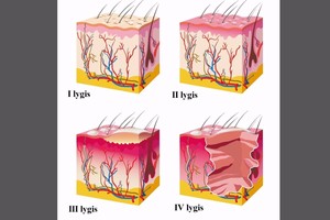 Šios sveikatos problemos dažnai aplanko vasarą – kaip jų išvengti?