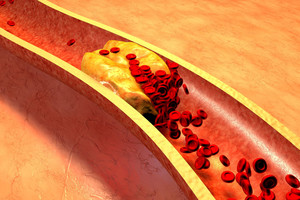 Mirtį nešantį cholesterolį pamiršite, išbandę šį paprastą receptą