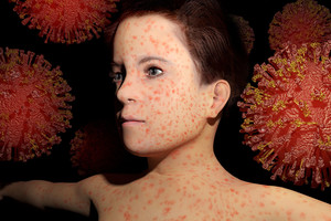 Sunkiomis komplikacijomis grasinanti liga turi tik vieną priešnuodį