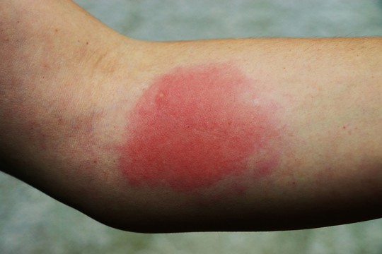 Išvyka į gamtą gali baigtis net mirtimi: svarbu žinoti, kaip apsisaugoti