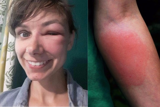 Išvyką į gamtą vilnietė pabaigė ligoninėje: „Džiaugiuosi, kad esu gyva“