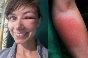 Išvyką į gamtą vilnietė pabaigė ligoninėje: „Džiaugiuosi, kad esu gyva“