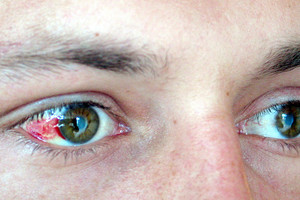 Didelis pavojus akims: prasideda perštėjimu ir ašarojimu