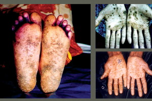 Raseiniuose geriamajame vandenyje aptikta nuodinga medžiaga gali sukelti baisių pasekmių