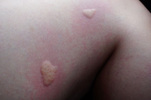 Po uodų įkandimų nepažino savęs veidrodyje: taip gali nutikti visiems