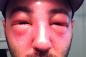 Vaikščiojimas basomis ar pyrago gabalėlis gali lemti mirtį – reaguoti privalote nedelsiant