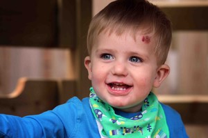 Emigrantų sūnaus kančios: oda plyšta lyg pernokusi slyva