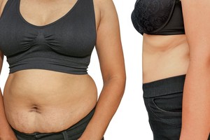 Tokia dieta padės sulieknėti, bet gali stipriai pakenkti organizmui