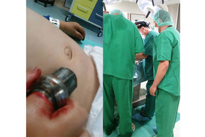 Vilniaus ugniagesiai talkino medikams – išgelbėjo mažo berniuko pirštą