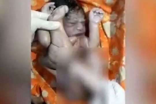 Šeima šį kūdikį norėjo nuskandinti, bet neabejingas chirurgas jį išgelbėjo