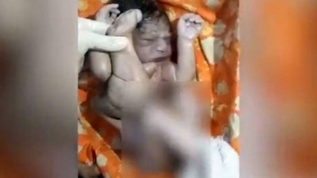Šeima šį kūdikį norėjo nuskandinti, bet neabejingas chirurgas jį išgelbėjo