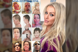 Pavyduolės padegta moteris papasakojo, kokį košmarą teko patirti