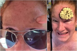 Dėmelę ant kaktos pastebėjusi moteris tokios diagnozės nesitikėjo