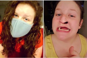 Mirtiną vėžio formą išsigydžiusi mergina pasidalino šokiruojančiomis nuotraukomis