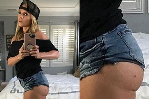 Vėžiu serganti „Tikrų namų šeimininkių“ žvaigždė parodė, kaip atrodo melanoma