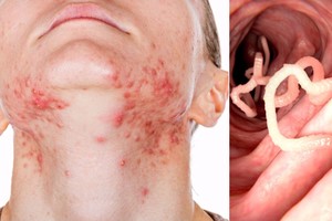 18 požymių, kad jūsų organizme knibžda parazitai ir kaip juos įveikti