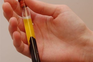 Vaiko sveikatos patikra dėl „varnelės“ – kokia rizika? 