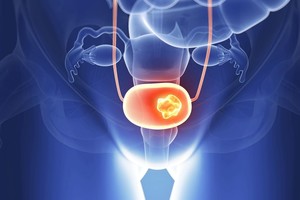 Padažnėjo šlapinimasis ar jaučiate deginimą? Gali būti, kad sergate vėžiu