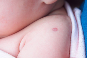 Viršutinėje rankos dalyje turite tokį randą? Štai ką jis reiškia