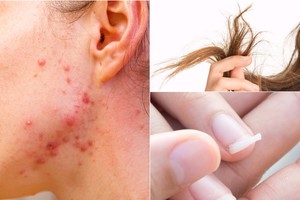 Vargina sausi plaukai, silpni nagai ar odos bėrimai? Štai, kas gali padėti