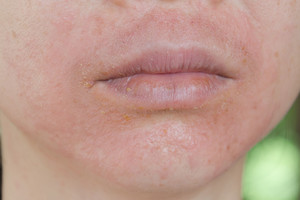 Vargina niežulys? Štai, ką būtinai turite žinoti