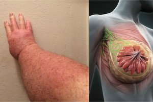 Nuo meškos ant vilko: vilnietė išvengė mirties, bet ranka ėmė tinti dvigubai