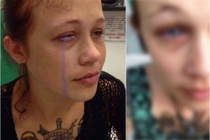 Moteriai ištatuiravo akies obuolį. Pasekmės – liūdnos