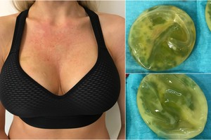 Vietoje džiaugsmo – didelė gėda: operacija moterį privertė slėptis