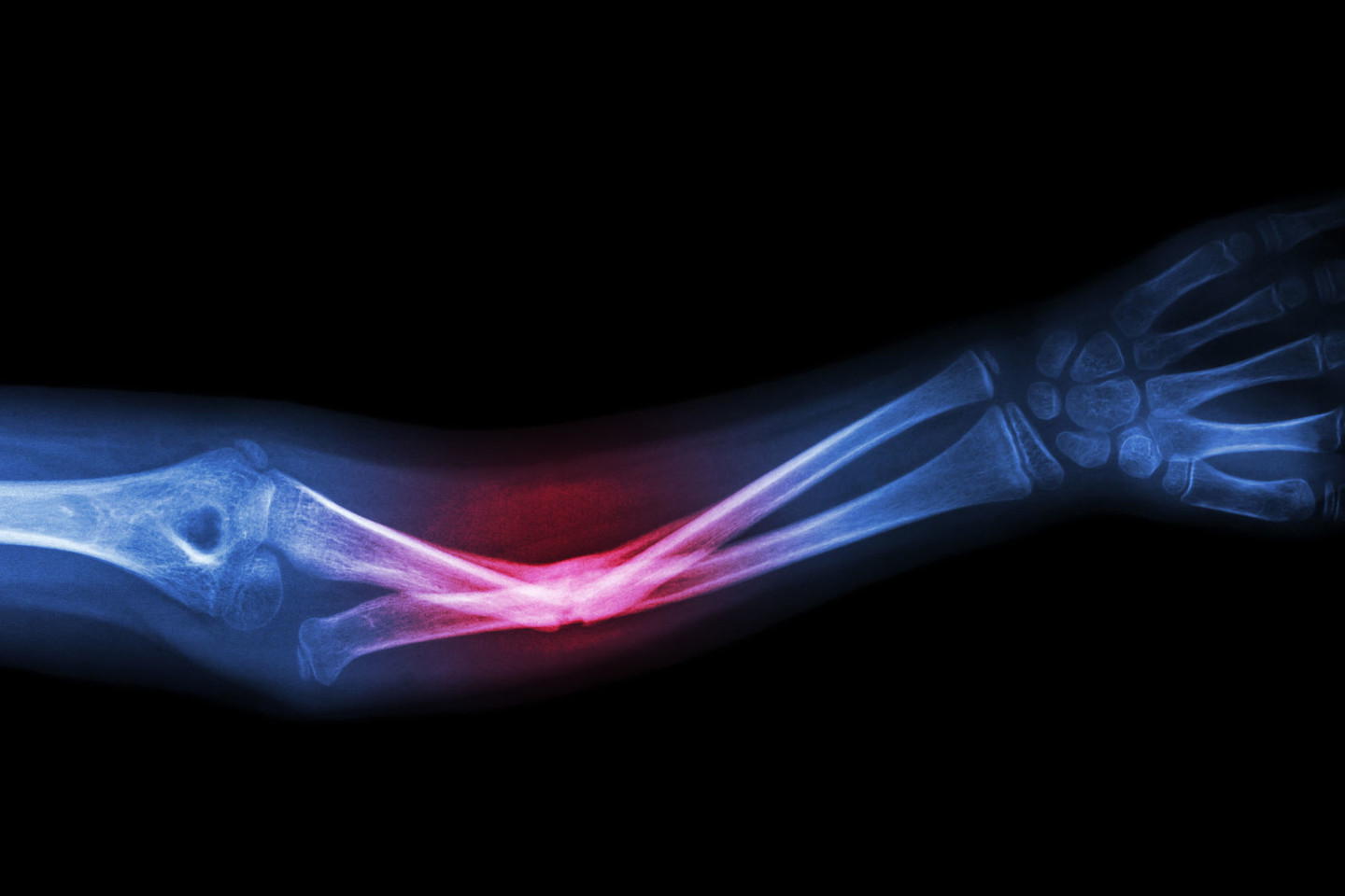  Sergant osteoporoze stipriai padidėja kaulų lūžių rizika.<br> 123rf.com asociatyvi nuotr.