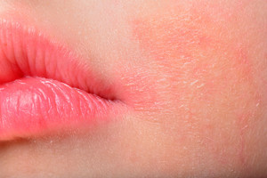 Paaiškino, kaip prižiūrėti odą paspaudus šaltukui