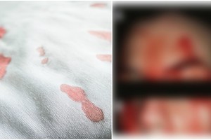 Medikai suglumo: iš moters porų vietoj prakaito pasipylė kraujas