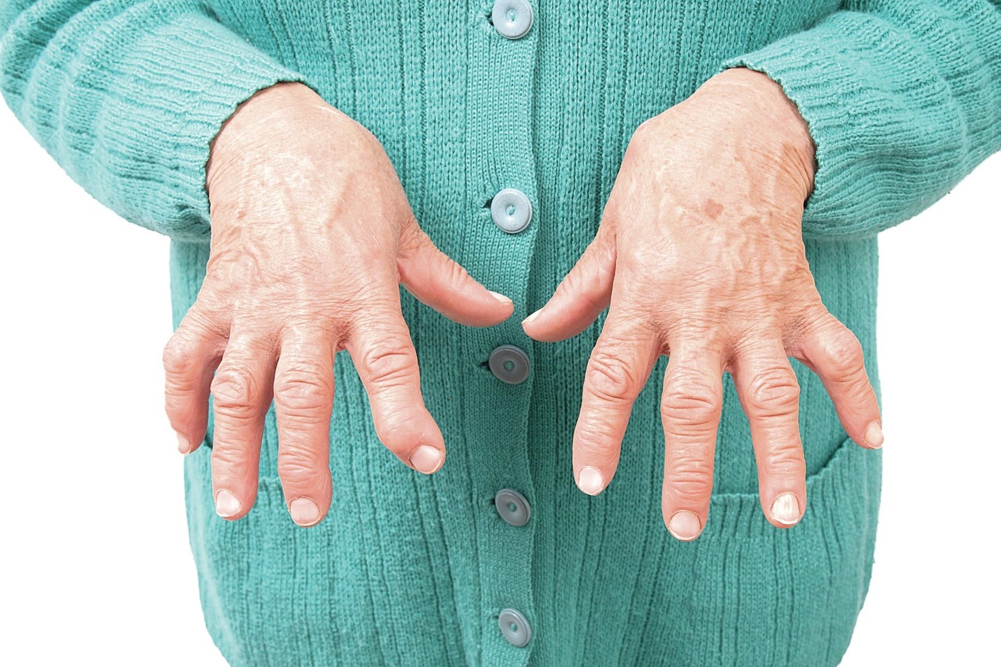 kaip sustabdyti artrita