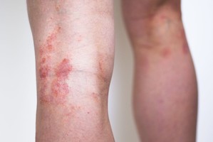 Po visą kūną „migruojanti“ odos liga gali užklupti kiekvieną