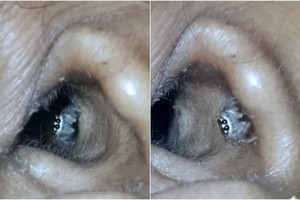 Medikai išsižiojo: moters galvos skausmo priežastis tūnojo ausyje