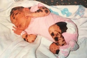 Mergaitė gimė padengta apgamais. Štai kaip ji atrodo šiandien