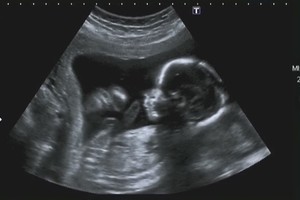 Neįtikėtina istorija: būdama nėščia moteris pastojo dar kartą