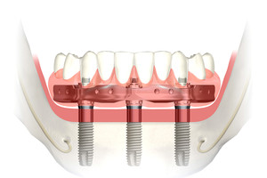 Apatinio žandikaulio dantų atkūrimas ant 3 implantų!