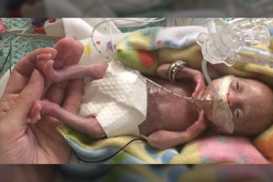 22 nėštumo savaitę gimusi mažylė: kaip sekasi praėjus 3 metams