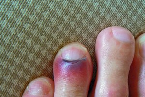 Klastinga liga suserga tūkstančiai, o komplikacijos griauna gyvenimus – štai kaip jų išvengti