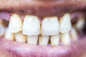 Pasakė niūrią tiesą apie burnos sveikatą – rūkaliams tai nepatiks