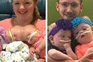 Šių dvynukių istorija virpina milijonų širdis