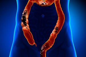 Kasdienis įprotis jus žudo: gali sukelti net vėžį ir insultą