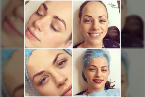 Ineta Žvagulienė išbandė veido dailinimo procedūras: rezultatas stulbina