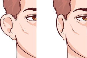 Atlėpusios ausys: nuo patyčių iki plastinės operacijos