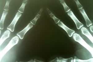 Pirmoji rentgeno nuotrauka išgąsdino pacientę: moteris išvydo kažką baisaus