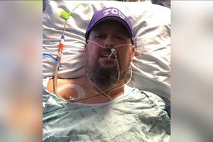 Dažna virusine infekcija susirgęs vyras neteko galūnių. Perspėja ir kitus