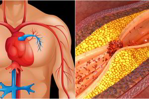 Svarbu žinoti: šie produktai padės apsaugoti kraujagysles nuo trombų