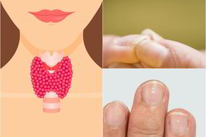 Svarbu įsidėmėti: silpni, grublėti ar lūžinėjantys nagai įspėja apie ligą